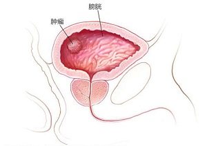 郑州看膀胱肿瘤好的中医馆:警惕“怪脾气”的膀胱癌