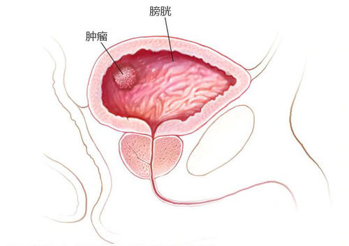 膀胱癌对人体的5大伤害